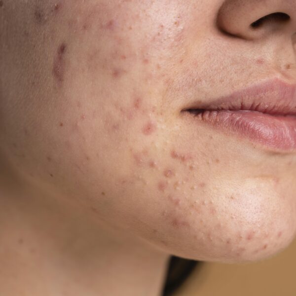 Hyperpigmentation